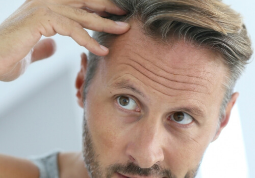 Primeros signos de la alopecia