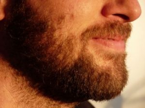 Trasplante de barba y bigote